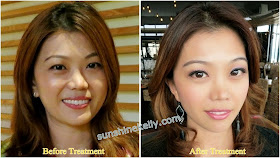 Thermage Treatment Face Hands Knees, thermage treatment, solta medical, Damansara Heights Wellness Clinique, non invasive radio frequency, non surgical face lift