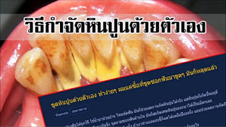   ขูดหินปูนเอง, ที่ขูดหินปูน 7-11, ขูดหินปูนเอง pantip, ที่ขูดซอกฟัน, ที่ขูดหินปูน dentiste, ที่ขูดหินปูน เซเว่น, เหล็กขูดหินปูน ราคา, ที่ขูดซอกฟัน เดนทิสเต้, คราบ หินปูน สี ดำ