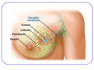 como inicia el cancer de seno, como prevenir el cancer de seno, imagenes de cancer de seno, tratamiento del cancer de mama, sintomas de cancer de seno avanzado, dolor en el seno, sintomas de cancer de mamas+imagenes, 12 sintomas del cancer de mamas+imagenes, sintomas de cancer de mama- dolor de brazo