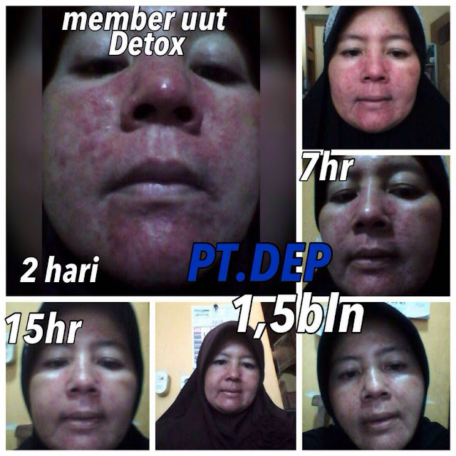 TESTIMONI SABUN AMOOREA JERAWAT