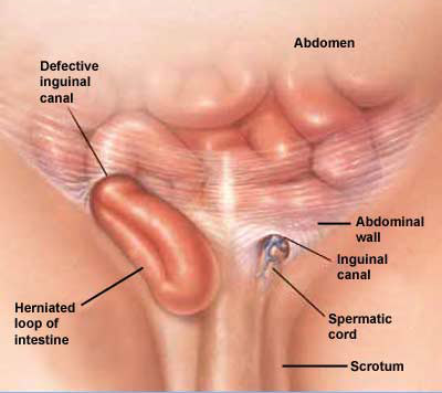 umbilical hernia in adults. of hernia paraumbilical