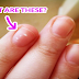 White Spots On Your Nails: What They Causes And Really Mean For Your Health