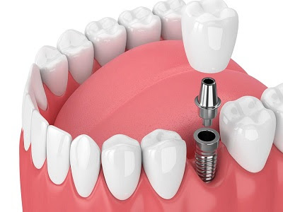 Dental Implants Market - TechSci Research