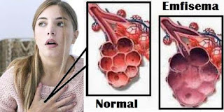 penyakit emfisema