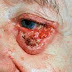 Cáncer de piel de células basales- síntomas , causas, tratamientos y prevención
