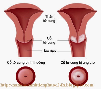 Hình ảnh minh họa ung thư cổ tử cung