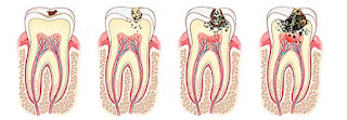 Pulpitis