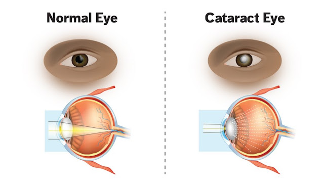 WHAT IS CATATACT? MAIN CAUSE ? TYPES OF CATARACT, SIGNS AND SYMPTOMS, HOW CAN YOU TREAT? CATARACT VISION, TREATMRNT