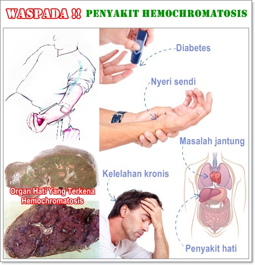 Pengobatan Herbal Hemochromatosis Terbukti Ampuh