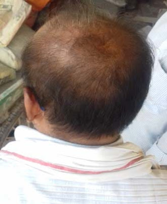 hair-loss-baldness-alopecia-areata-treatment-image