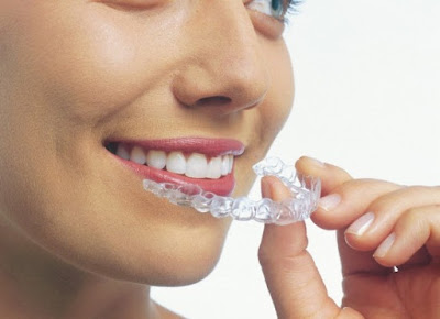 Trả lời niềng răng Invisalign giá bao nhiêu hiện nay?