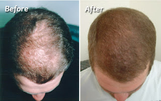 best fue clinic in pakistan http://www.snhc.com.pk/non-surgical-treatment.php