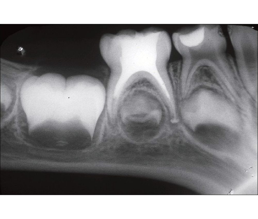 Endodoncia