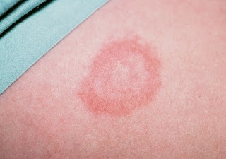 Gây bệnh Lyme