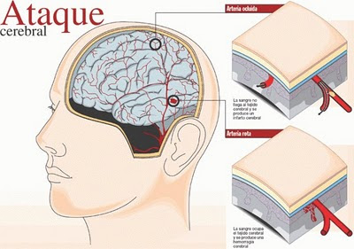 Derrame Cerebral