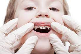 تسوس الاسنان عند الاطفال الاعراض والاسباب وطرق علاج تسوس الاسنان للاطفال