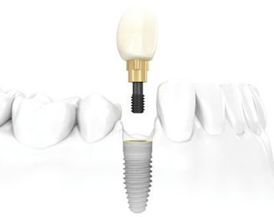  trường hợp nào nên cấy ghép implant