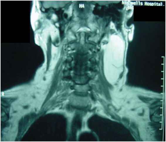 WHAT IS LIPOMA? WHAT CAUSES LIPOMA LUMPS? SYMPTOMS, WHAT IS INSIDE LIPOMA? DIAGNOSIS, BEST TREATMENT OF LIPOMA