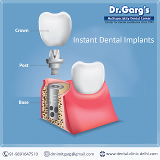 Instant Dental Implants