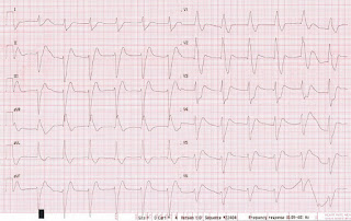   ekg คือ, ekg ผิดปกติ, ekg 12 lead ปกติ, normal sinus rhythm คือ, basic ekg, p wave คือ, การติด ekg monitor, กราฟคลื่นหัวใจผิดปกติ, ekg ย่อมาจาก