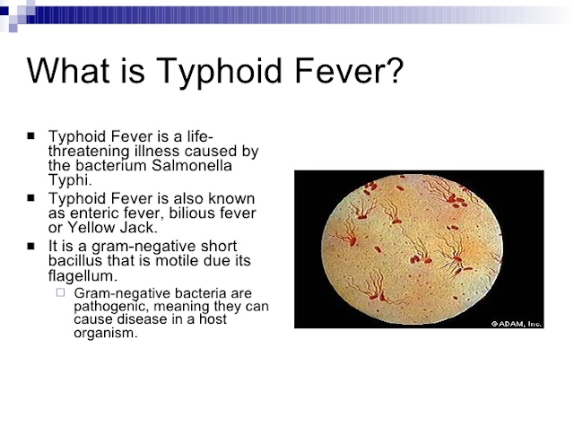 typhoid fever