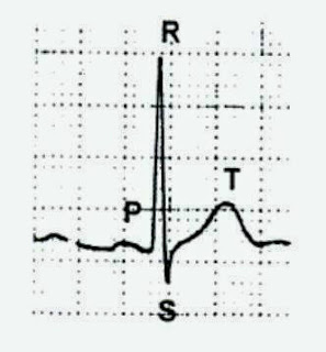 Gelombang-gelombang yang terbaca pada elektrokardiograf