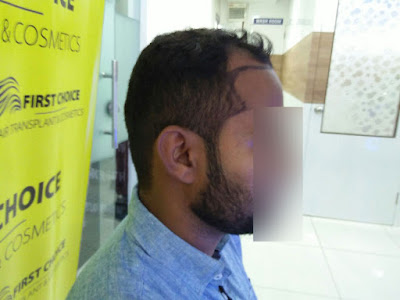 Hair Transplant results