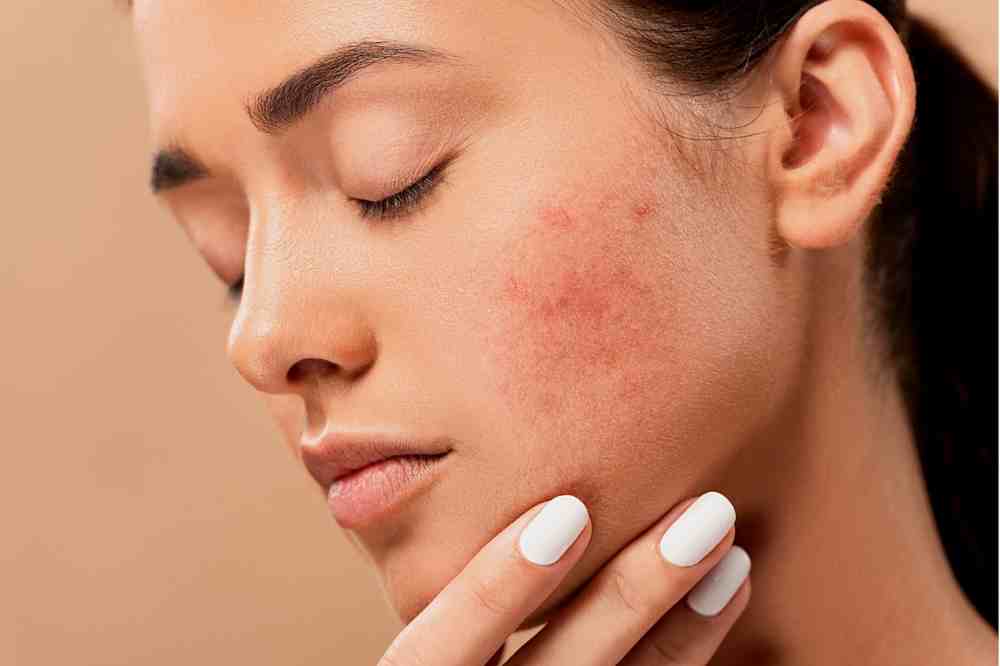 6 Tips To Get Rid Of Pimples Quickly