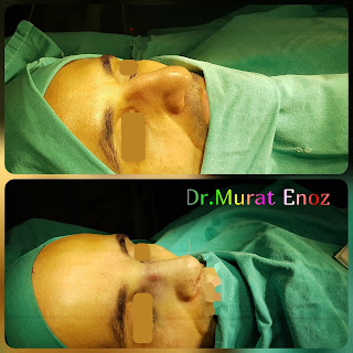 Nasal valve collapse,Alar collapse,Septorhinoplasty in istanbul,Rhinoplasty in men Turkey,