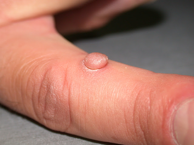 Earliest symptoms of cancer on your skin that you shouldn't ignore.