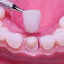 Bọc răng sứ bị nhức phải làm sao? 