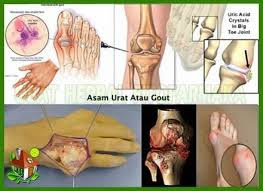 obat asam urat atau rematik