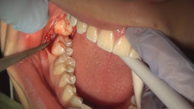 Why do we have wisdom teeth removed?