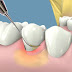 Điều trị sưng lợi chân răng hiệu quả
