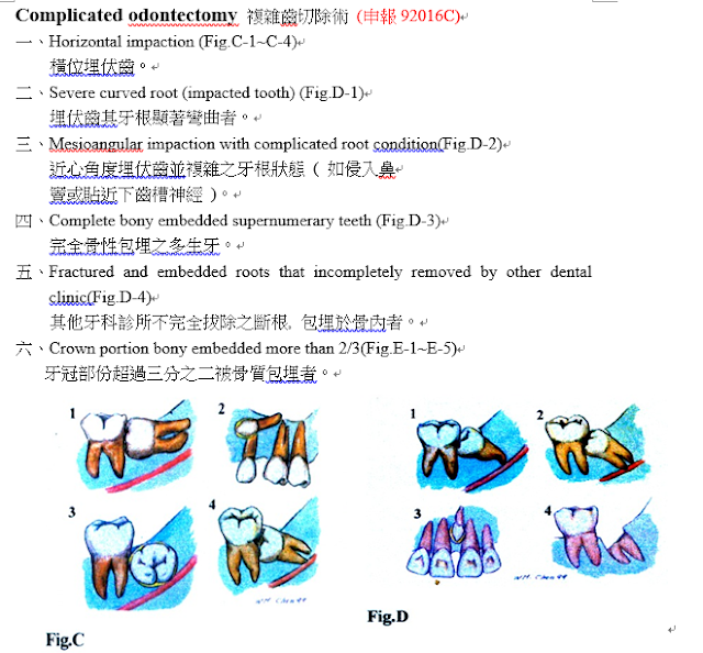 複雜性齒切除術圖示