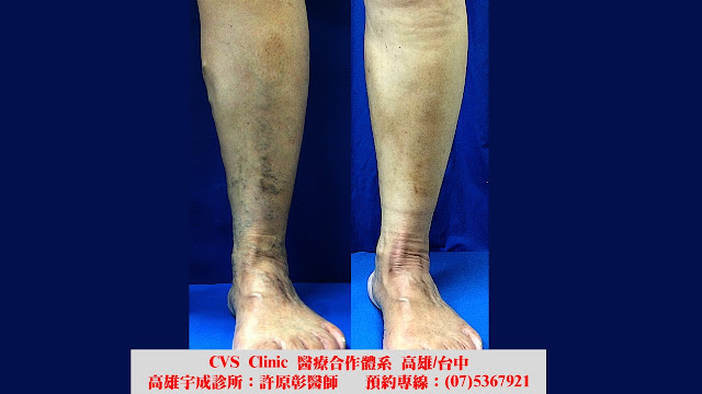 靜脈膠, 萬能膠, 黏膠閉合手術, 過敏反應, 類靜脈炎反應, 靜脈膠閉合手術, 微創靜脈勾除手術, 局部麻醉, 靜脈曲張, 蚯蚓狀, 網狀, 蜘蛛絲狀, 微創雷射手術, 硬化劑注射治療, 表皮雷射, 血栓靜脈炎, 色素沉澱, 腳痠脹, 腳疼痛, 血管超音波, varicose vein, EVLA, endovenous laser ablation, sclerotherapy, thrombophlebitis, reticular vein, spider vein, pigmentation, transcutaneous laser, Ambulatory phlebectomy, venaseal, vein glue, phlebitis, phlebitis-like abnormal reaction, PLAR, hypersensitivity 靜脈膠, 萬能膠, 黏膠閉合手術, 過敏反應, 類靜脈炎反應, 靜脈膠閉合手術, 微創靜脈勾除手術, 局部麻醉, 靜脈曲張, 蚯蚓狀, 網狀, 蜘蛛絲狀, 微創雷射手術, 硬化劑注射治療, 表皮雷射, 血栓靜脈炎, 色素沉澱, 腳痠脹, 腳疼痛, 血管超音波, varicose vein, EVLA, endovenous laser ablation, sclerotherapy, thrombophlebitis, reticular vein, spider vein, pigmentation, transcutaneous laser, Ambulatory phlebectomy, venaseal, vein glue, phlebitis, phlebitis-like abnormal reaction, PLAR, hypersensitivity