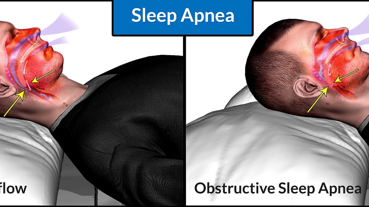 Cure Your Sleep Apnea Without Cpap