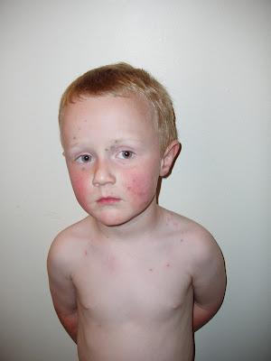 onset of chickenpox. varicella vaccine helps