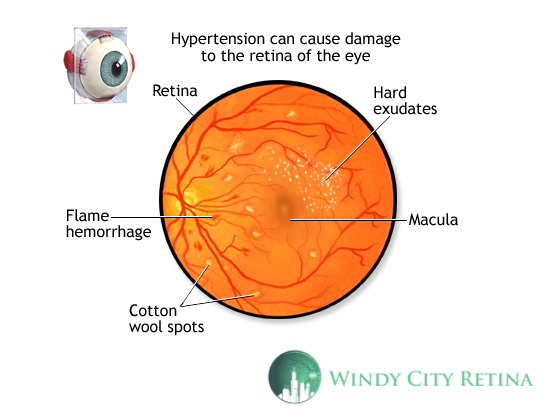 High Blood Pressure and Eye Diseases