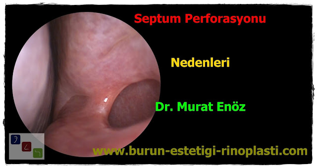 Septum perforasyonu tanımı - Septum perforasyonu  nedenleri - Septum perforasyonu belirtileri - Septum perforasyonu tedavisi - Açık teknik septum perforasyonu ameliyatı - Açık teknik septum perforasyonu onarımı - Burun duvarında delik