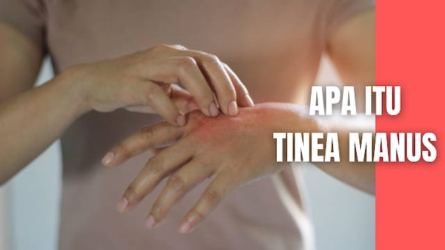 Apa Itu Tinea Manus Pada Manusia Tinea manus adalah dermatofitosis pada tangan yang sering terjadi unilateral pada tangan yang dominan digunakan dan sering berhubungan dengan Tinea pedis. Tinea manus biasanya asimptomatis, dengan perjalanan penyakit dalam hitungan bulan sampai tahun. Pada kebanyakan kasus tinea manus lebih sering terjadi unilateral dan terjadi pada usia dewasa. Etiologi tersering dari tinea manus adalah T. rubrum.  Tinea manus adalah infeksi jamur yang mengenai daerah sela jari – jari tangan, telapak tangan, dan punggung tangan. Penyakit ini sering menyerang orang yang bekerja di tempat basah seperti tukang cuci, pekerja di sawah, atau orang – orang yang setiap hari harus memakai sepatu yang tertutup seperti anggota militer. Keluhan subjektif bervariasi mulai dari tanpa keluhan sampai dengan rasa gatal yang hebat dan rasa nyeri bila ada infeksi sekunder.  Predileksi tinea manus ini terutama di daerah kulit telapak tanga, punggung tangan, jari – jari tangan, serta daerah interdigital.    Nah itu dia bahasan dari apa itu tinea manus pada manusia, melalui bahasan di atas bisa diketahui mengenai apa itu tinea manus pada manusia. Mungkin hanya itu yang bisa disampaikan di dalam artikel ini, mohon maaf bila terjadi kesalahan di dalam penulisan, dan terimakasih telah membaca artikel ini."God Bless and Protect Us"