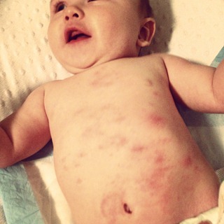 20130129 ames eczema (3)