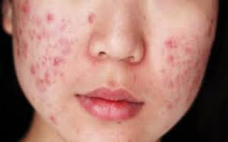 acne pimples