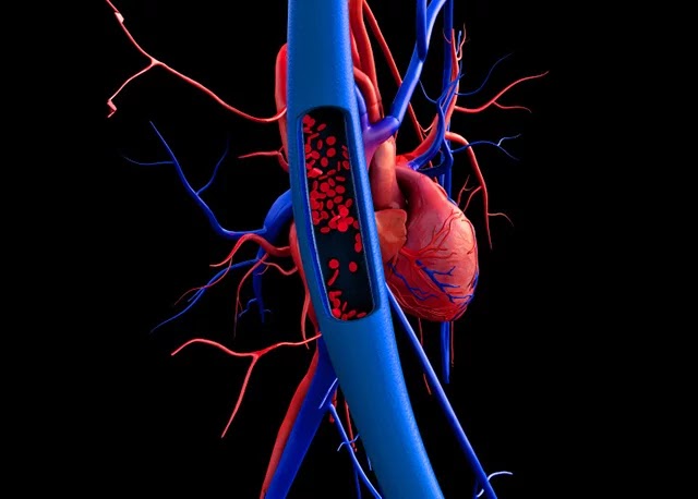 Vena cava inferior