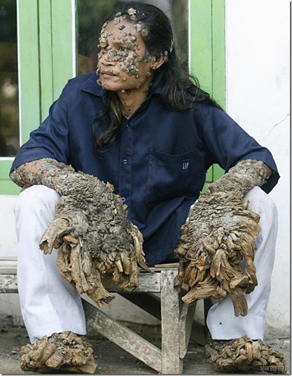 tree man pictures. Tree Man Dede Koswara.