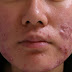 This is a compilation of how to easily get rid of acne naturally