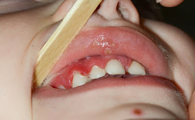 Dấu hiệu và cách điều trị viêm chân răng ở trẻ