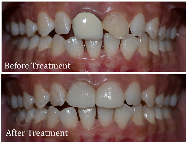 Cosmetic Dental Treatment at Jamnagar