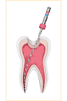 Lima realizando la rectificación de la raíz de un molar <img src="Concepto_endodoncia.gif" width="400" height="600" border="0" alt="Animación que muestra el procedimiento de endodoncia y los factores que influyen en su duración y éxito" />