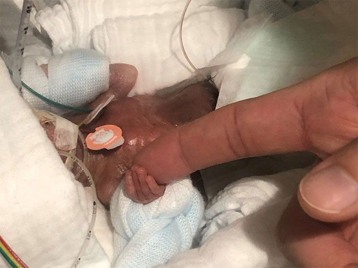 The Tiniest Surviving Premature Baby In The World Has Been Finally Sent Home After Months In The Hospital
